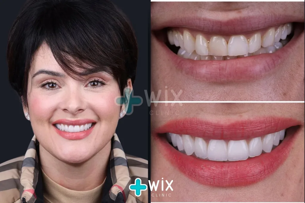 Hollywood Smile Before and After