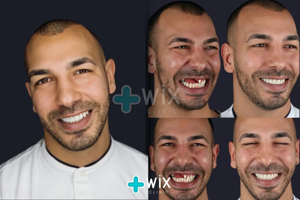 Hollywood Smile Before and After