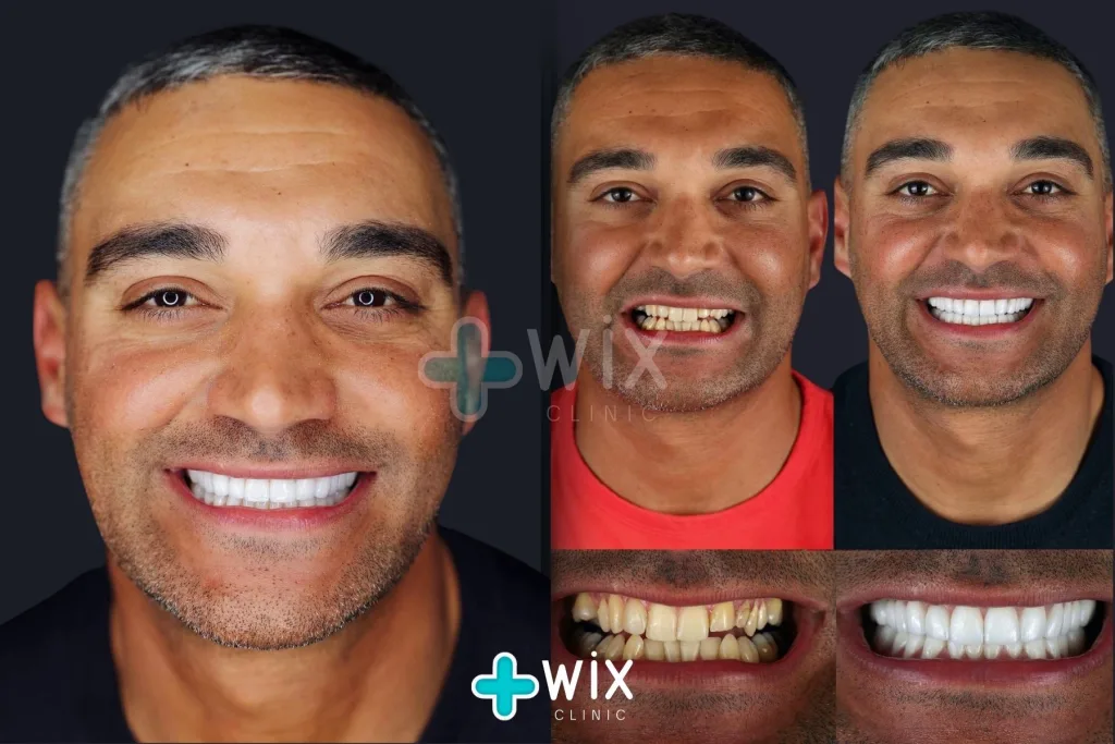 Hollywood Smile Before and After