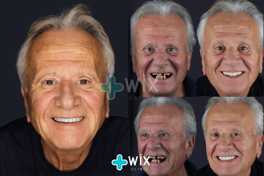 Hollywood Smile Before and After