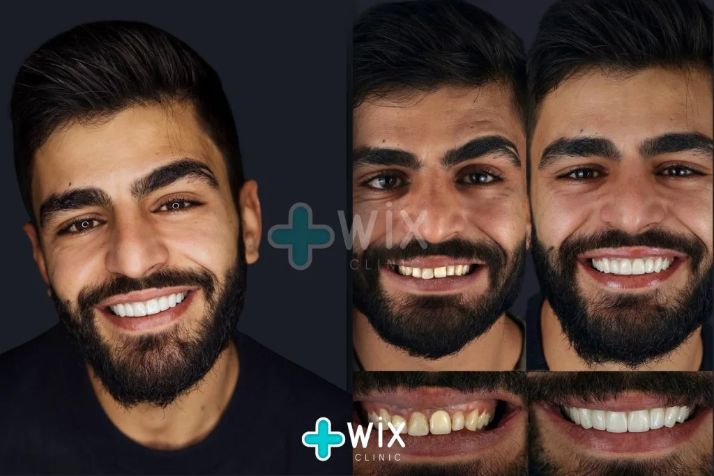 Hollywood Smile Before and After