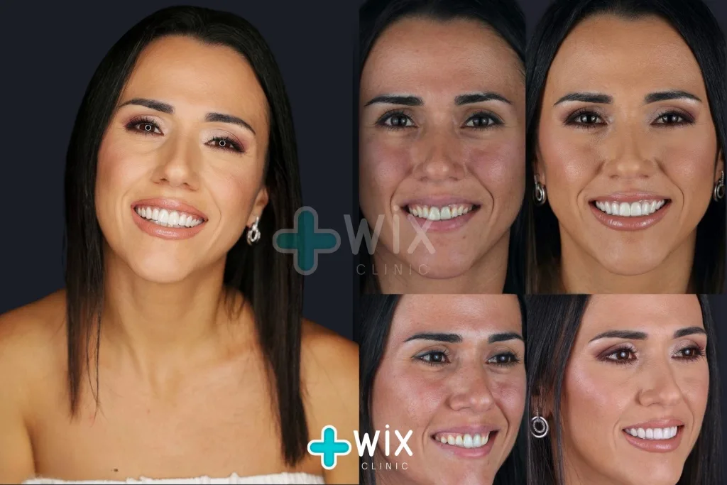 Hollywood Smile Before and After