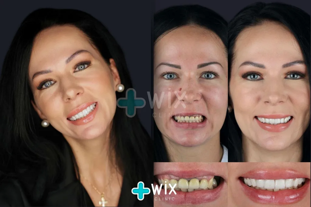 Hollywood Smile Before and After