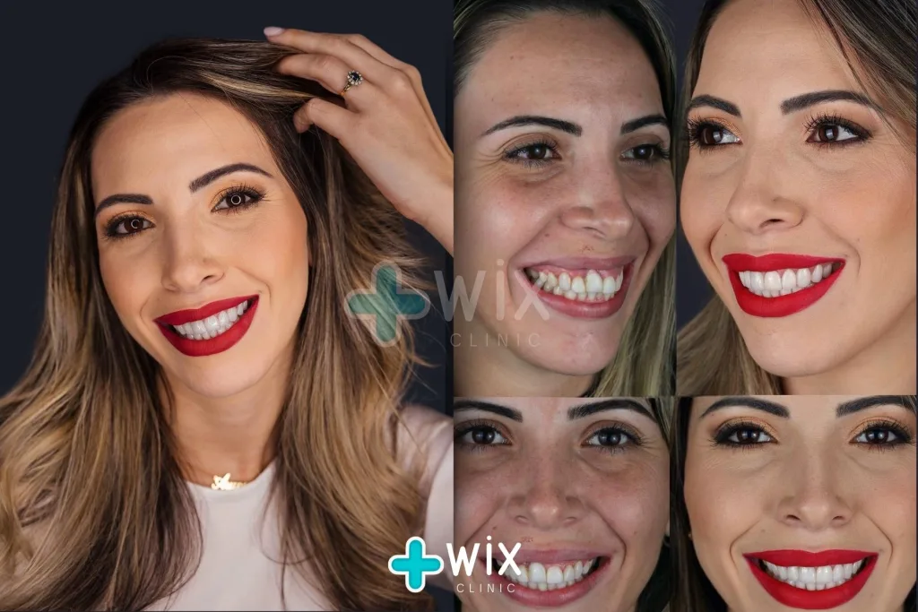 Hollywood Smile Before and After