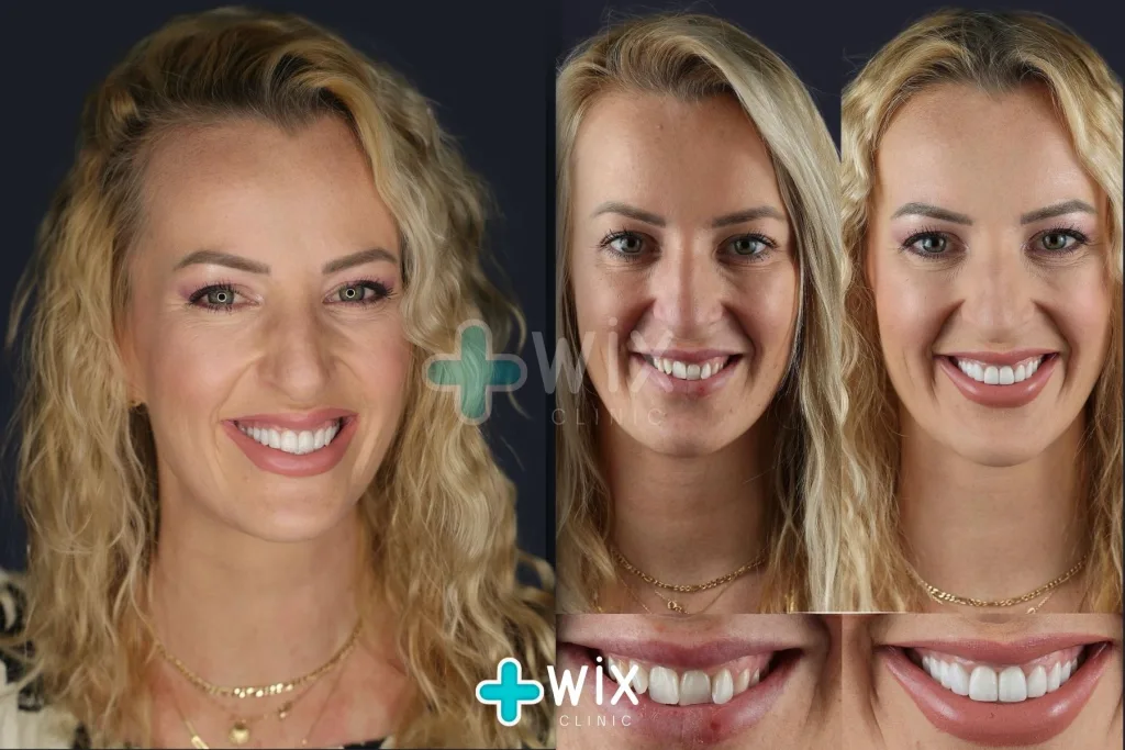 Hollywood Smile Before and After