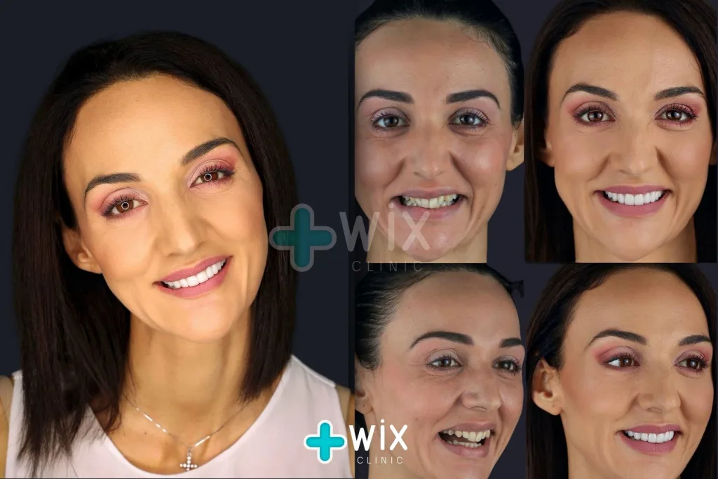 Hollywood Smile Before and After