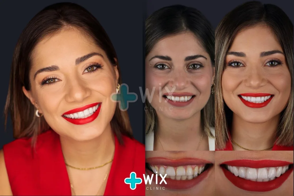 Hollywood Smile Before and After