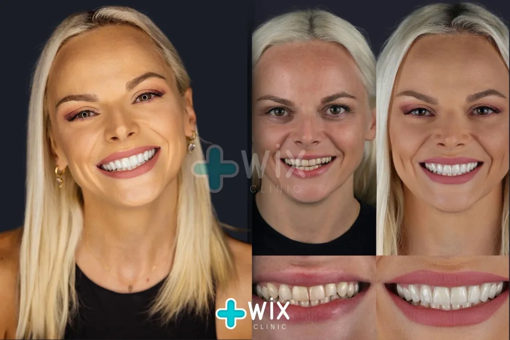 Hollywood Smile Before and After