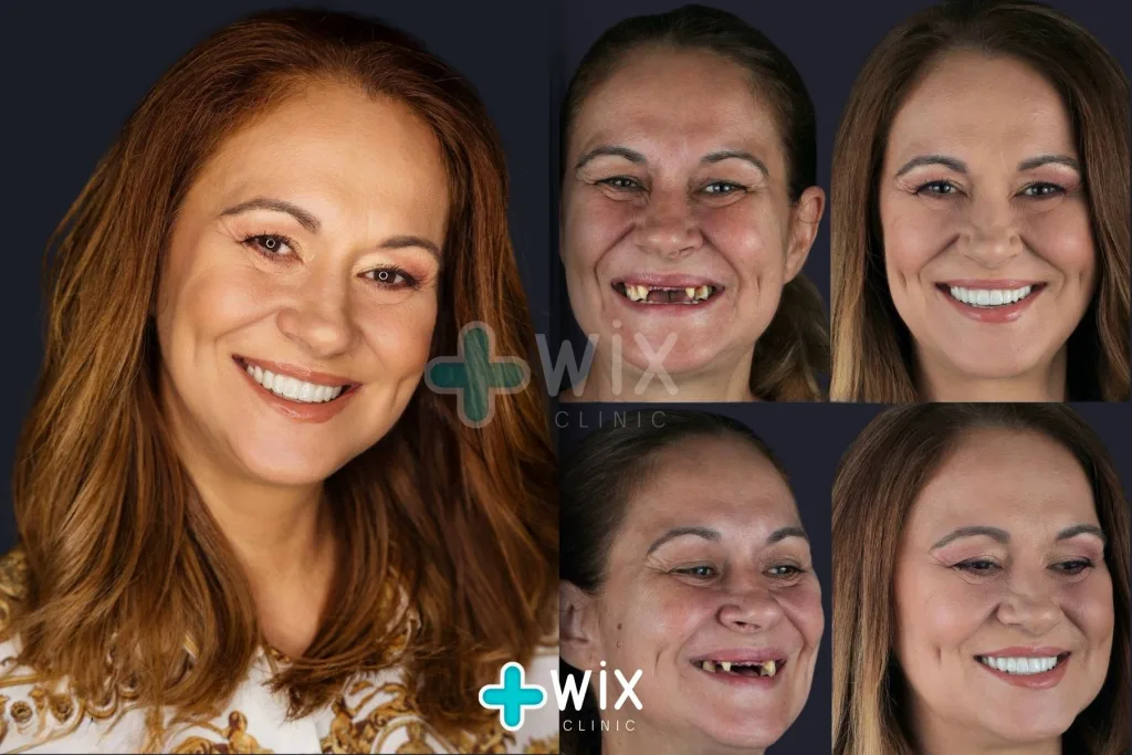 Hollywood Smile Before and After