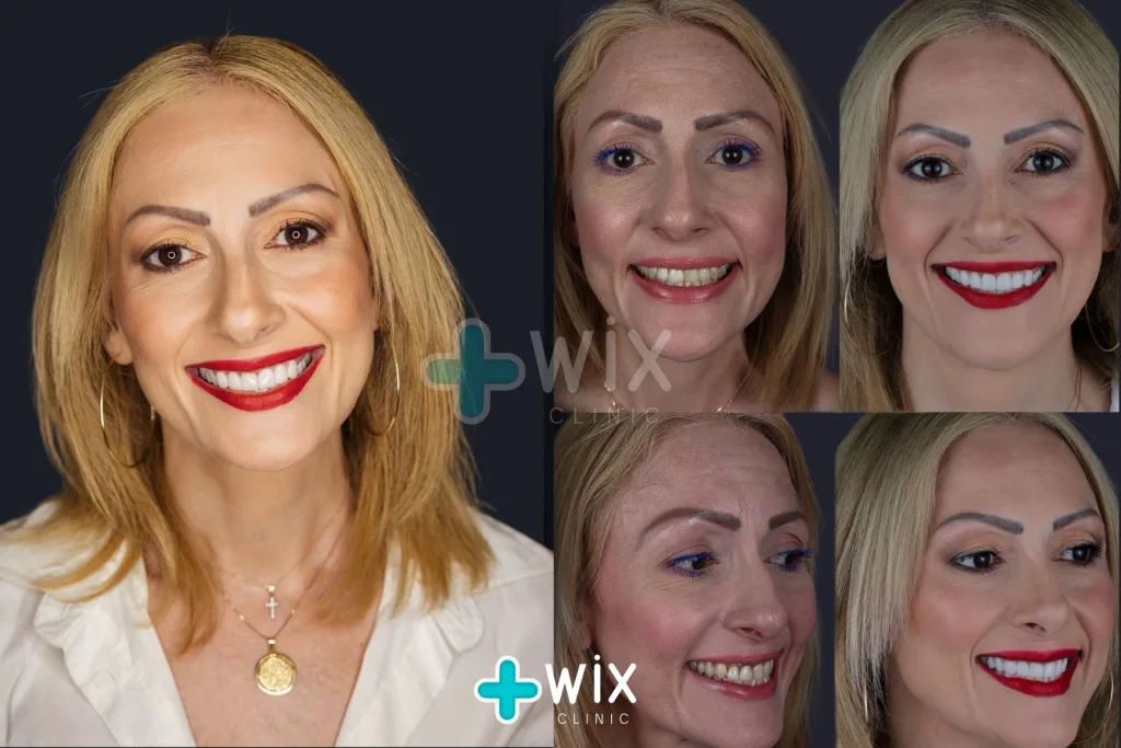 Hollywood Smile Before and After