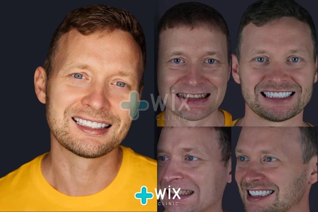 Hollywood Smile Before and After