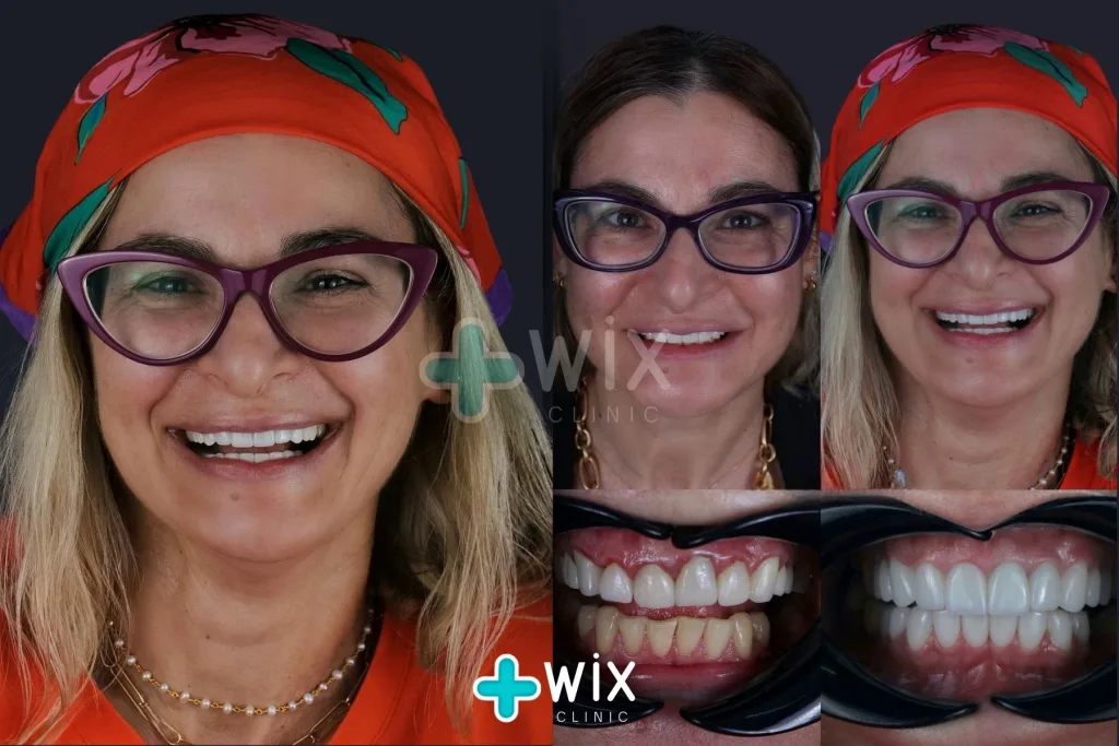 Hollywood Smile Before and After