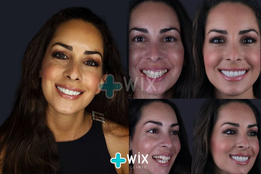 Hollywood Smile Before and After