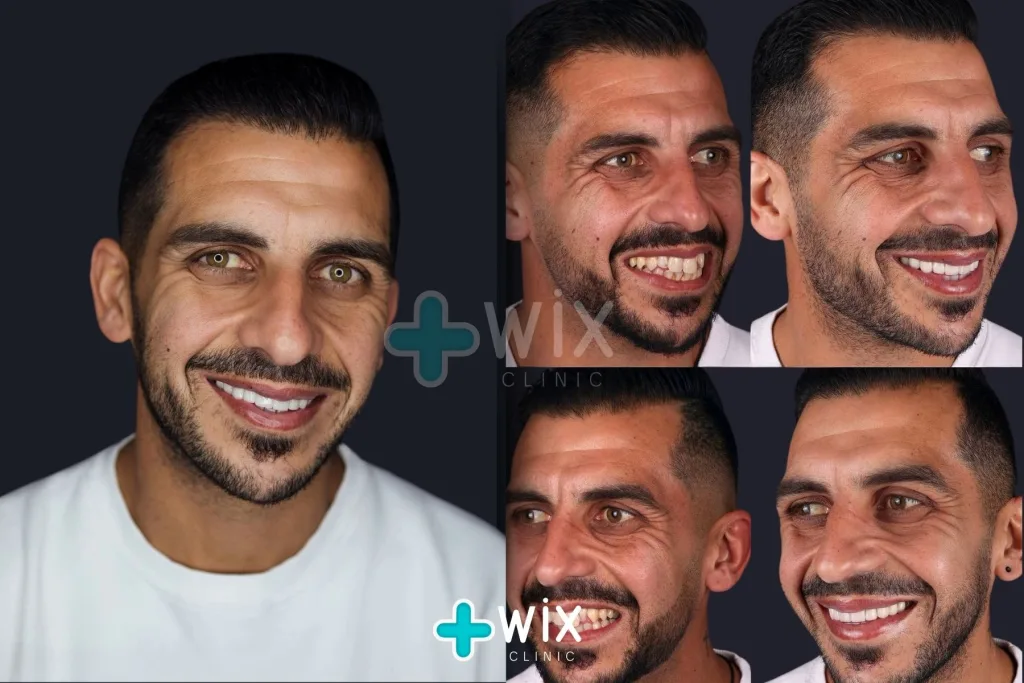 Hollywood Smile Before and After