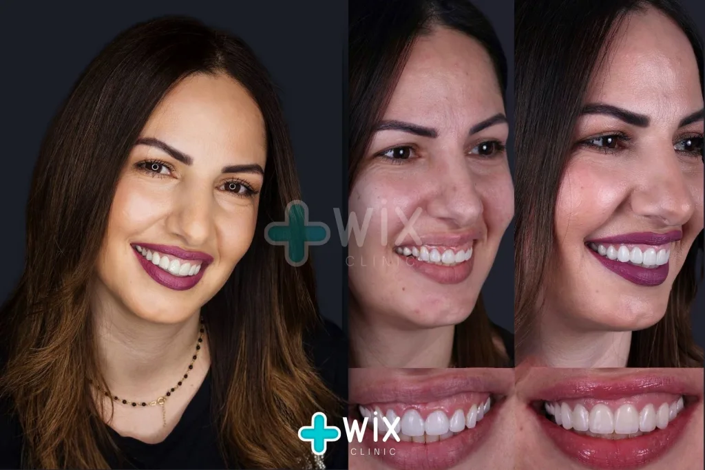 Hollywood Smile Before and After