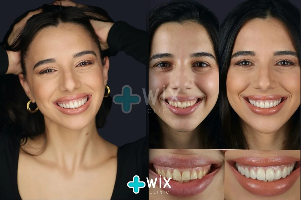 Hollywood Smile Before and After