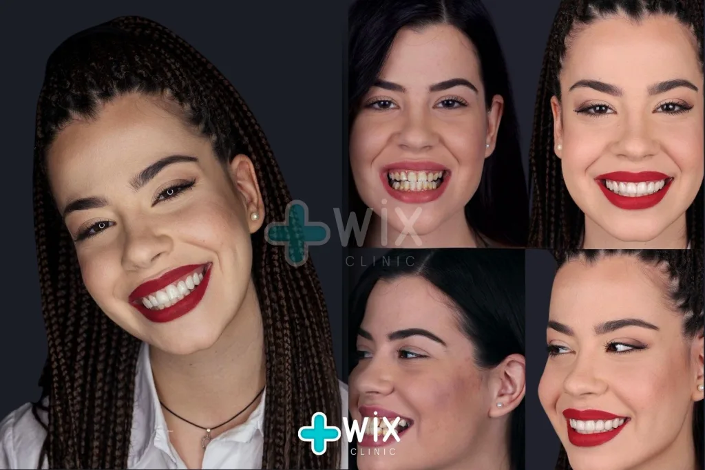 Hollywood Smile Before and After