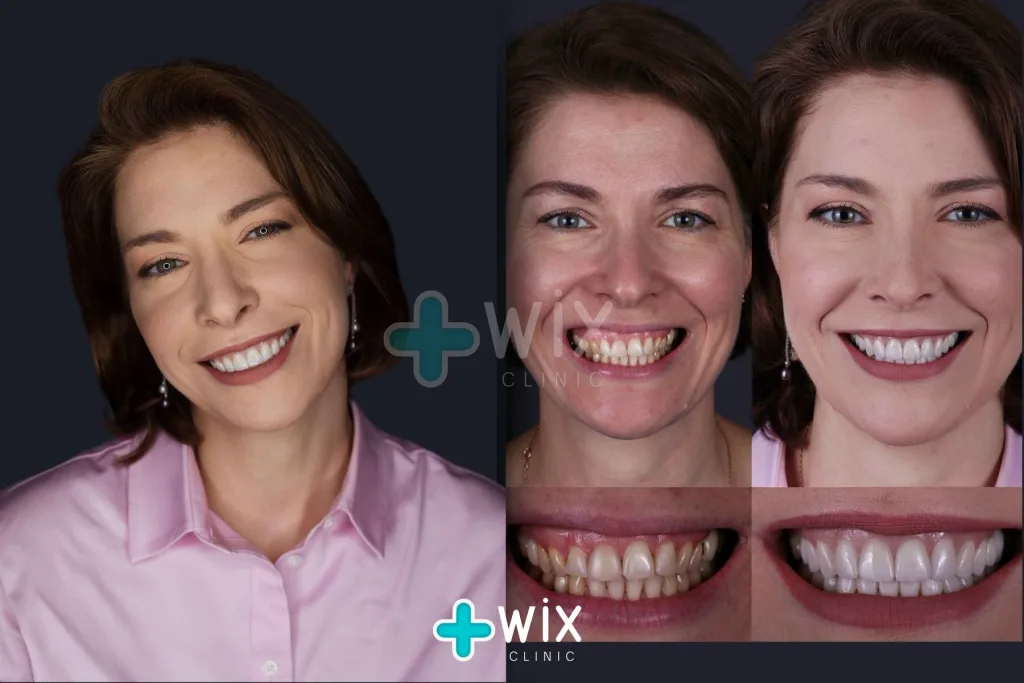 Hollywood Smile Before and After