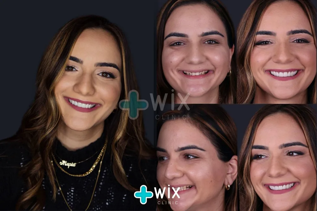 Hollywood Smile Before and After