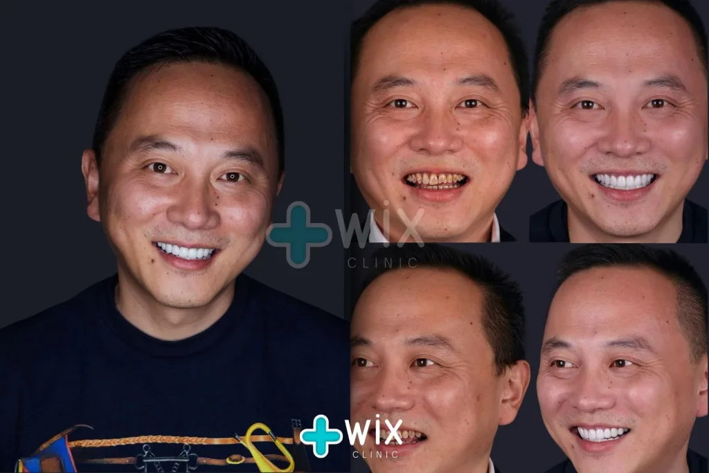 Hollywood Smile Before and After