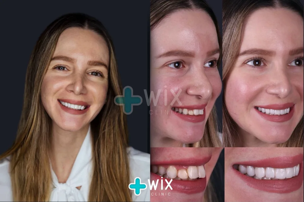 Hollywood Smile Before and After