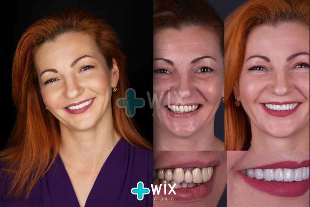 Hollywood Smile Before and After