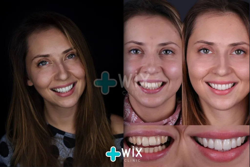 Hollywood Smile Before and After