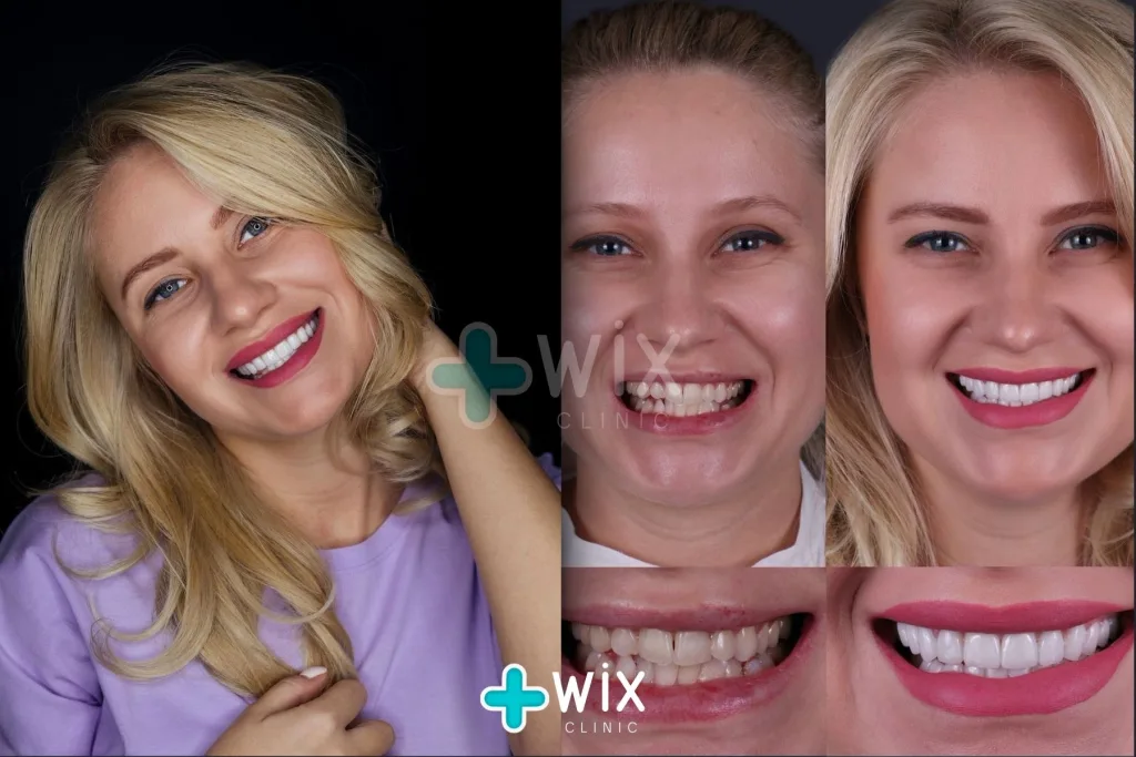 Hollywood Smile Before and After