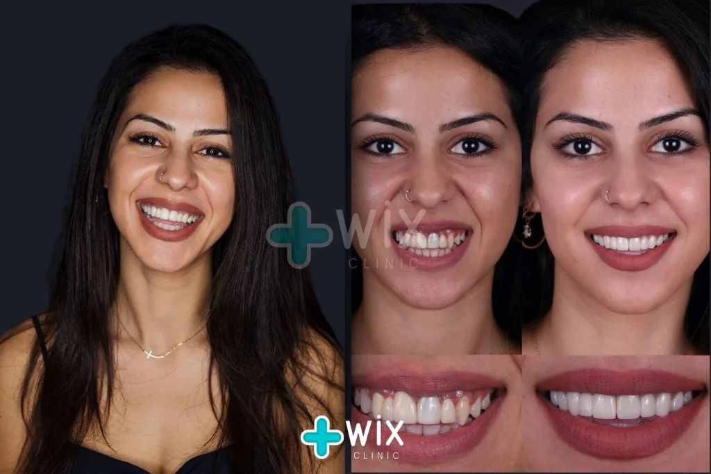 Hollywood Smile Before and After