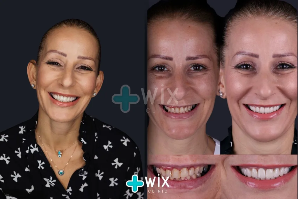 Hollywood Smile Before and After