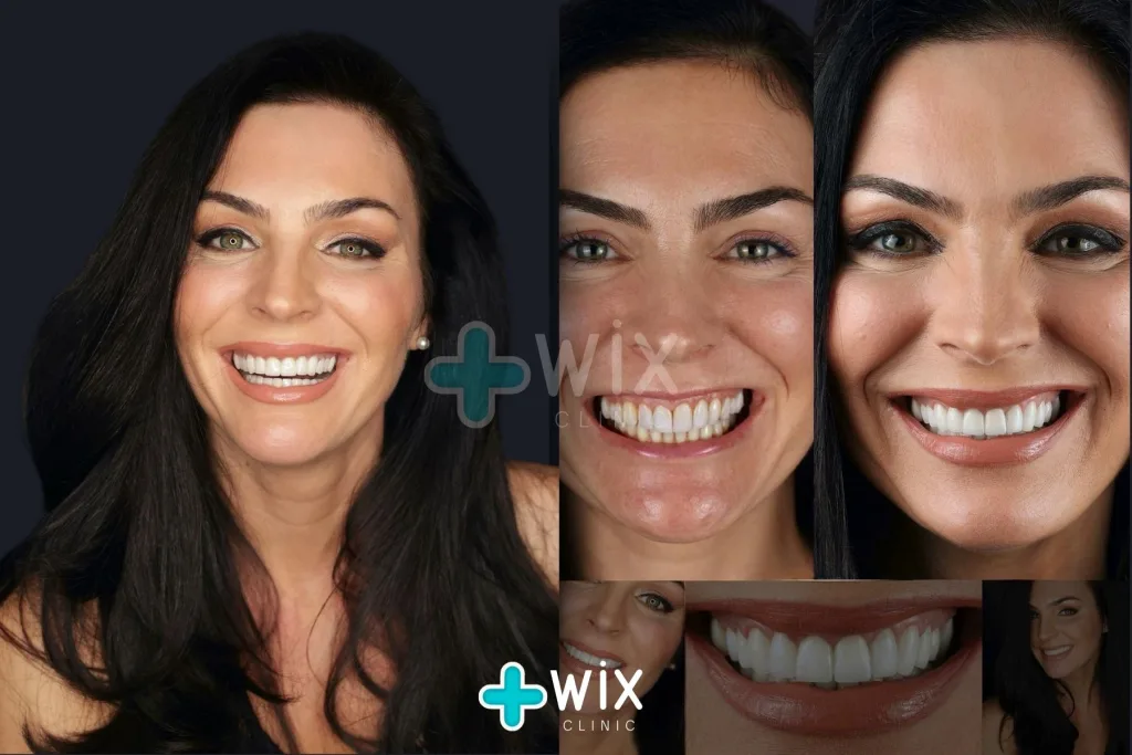 Hollywood Smile Before and After