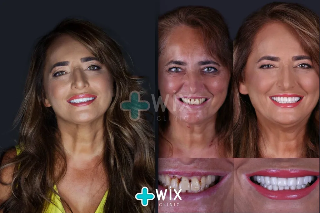 Hollywood Smile Before and After