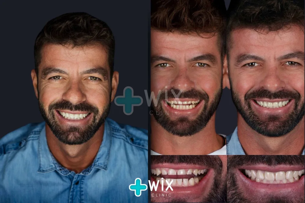 Hollywood Smile Before and After