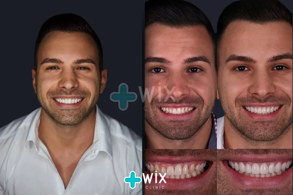 Hollywood Smile Before and After