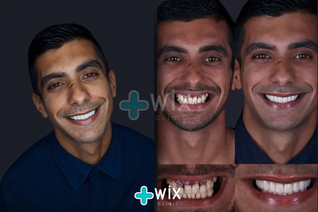 Hollywood Smile Before and After