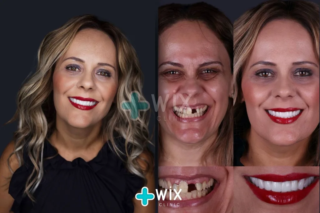 Hollywood Smile Before and After