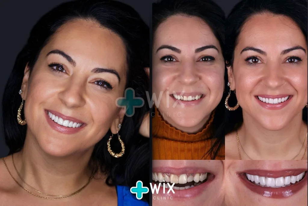 Hollywood Smile Before and After