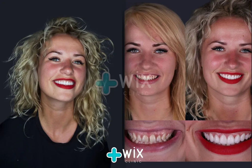 Hollywood Smile Before and After