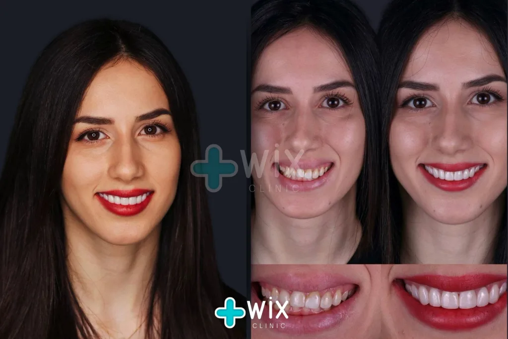 Hollywood Smile Before and After