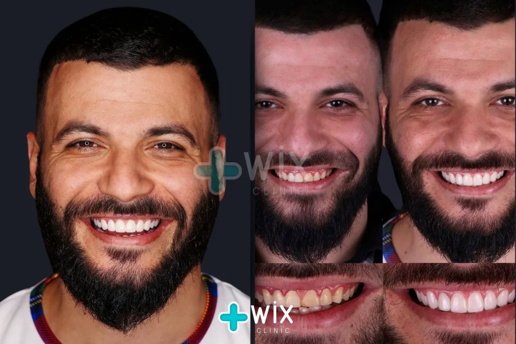 Hollywood Smile Before and After