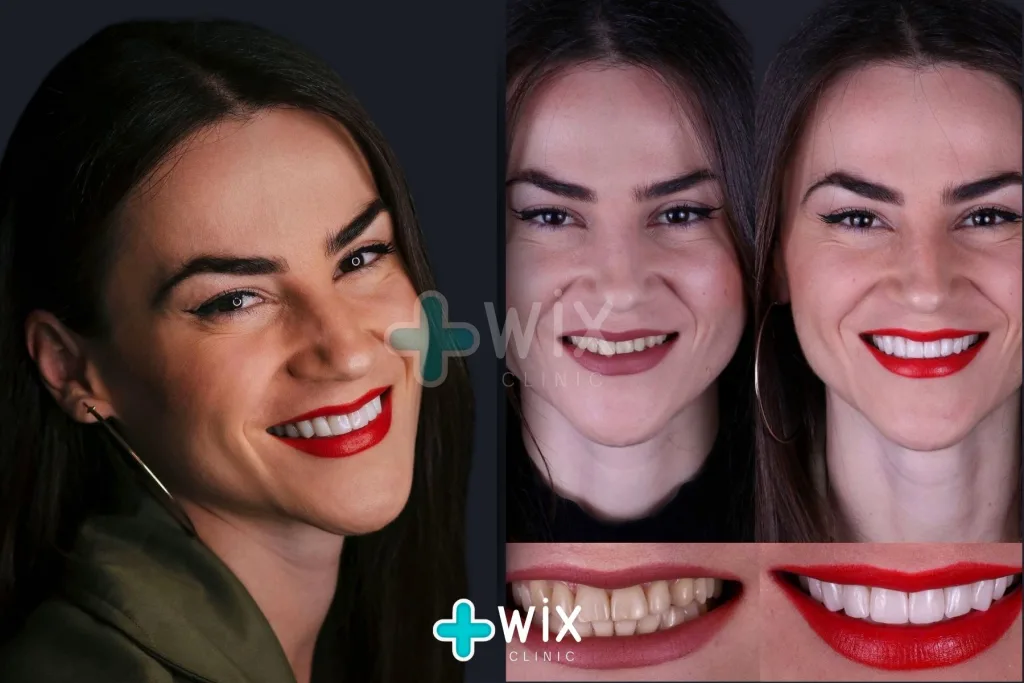 Hollywood Smile Before and After