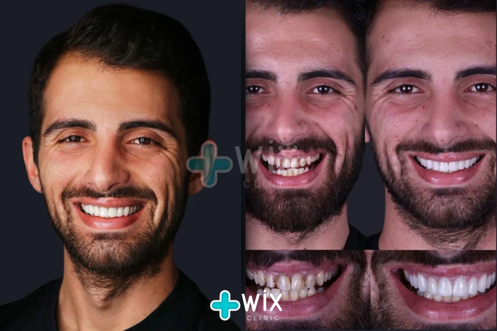 Hollywood Smile Before and After