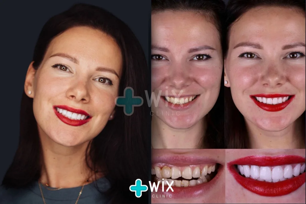 Hollywood Smile Before and After