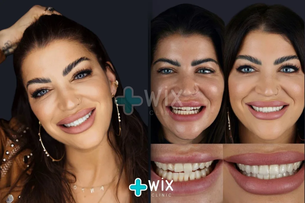 Hollywood Smile Before and After