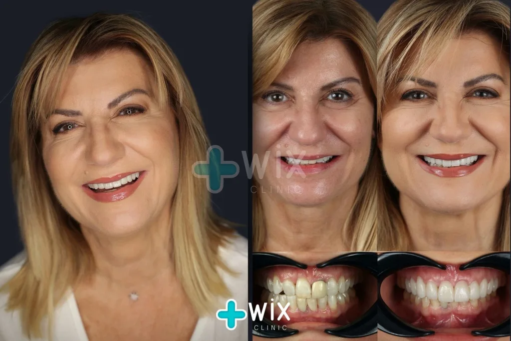 Hollywood Smile Before and After