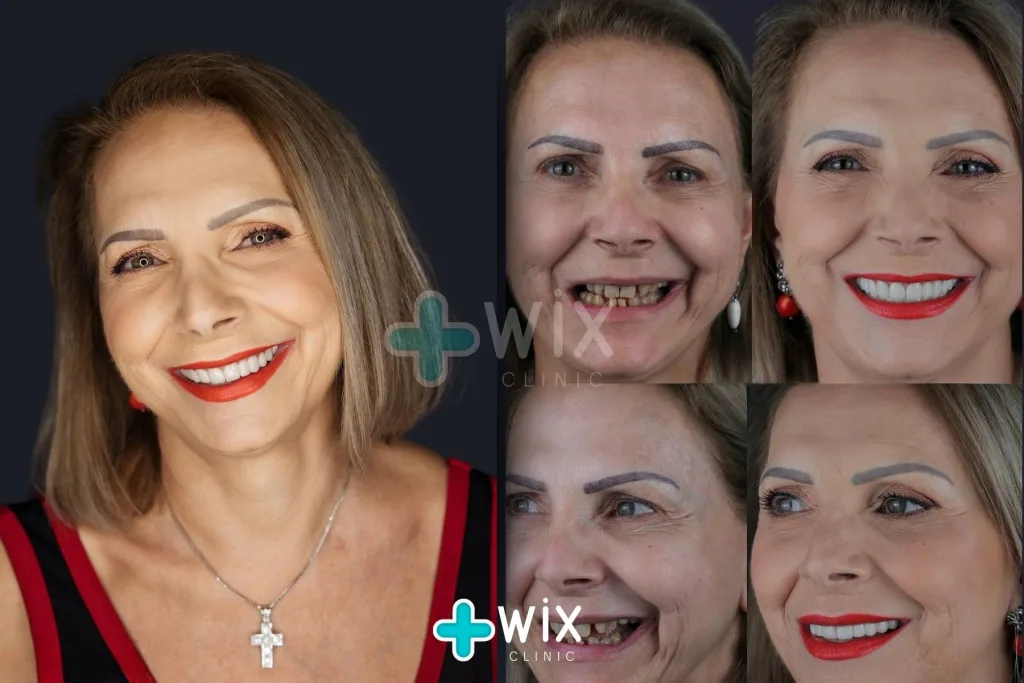 Hollywood Smile Before and After