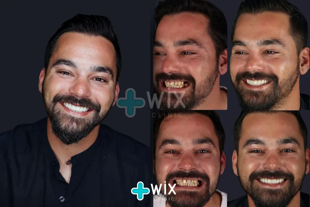 Hollywood Smile Before and After