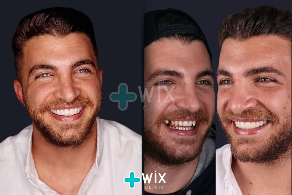 Hollywood Smile Before and After