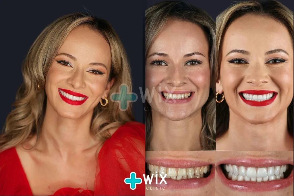 Hollywood Smile Before and After