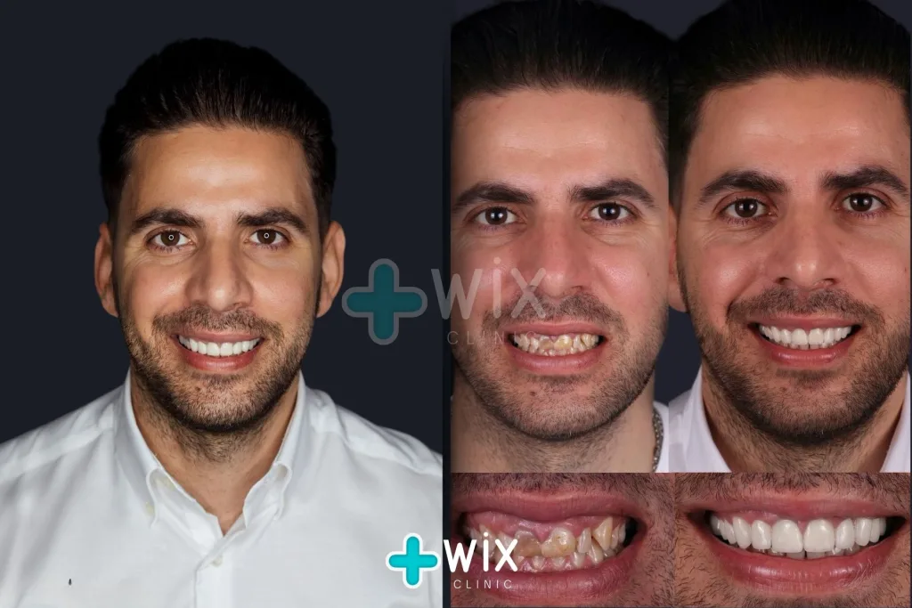 Hollywood Smile Before and After